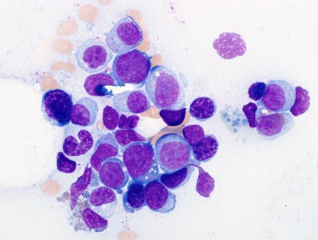 Bone marrow aspirate: blast morphology
